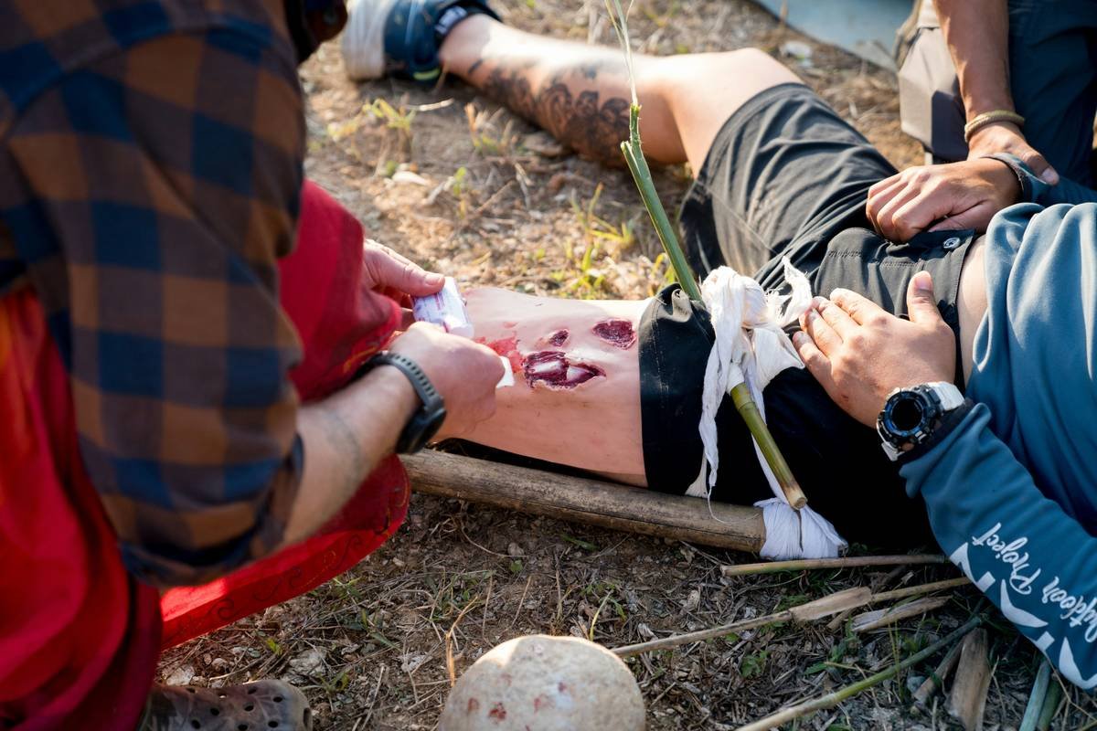 What Happens When You Break Your Leg Abroad and Your Credit Card Travel Insurance Emergency Medical Aid Saves (or Sinks) You?